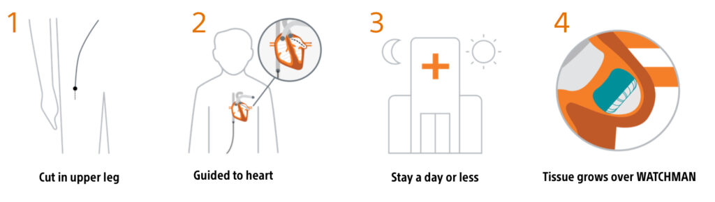 boston scientific cardiology steps for the watchman implantation