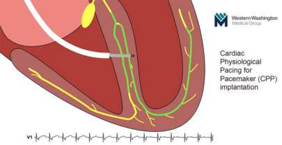 Cardiac Physiological Pacing for Pacemaker (CPP) | WWMG Blog