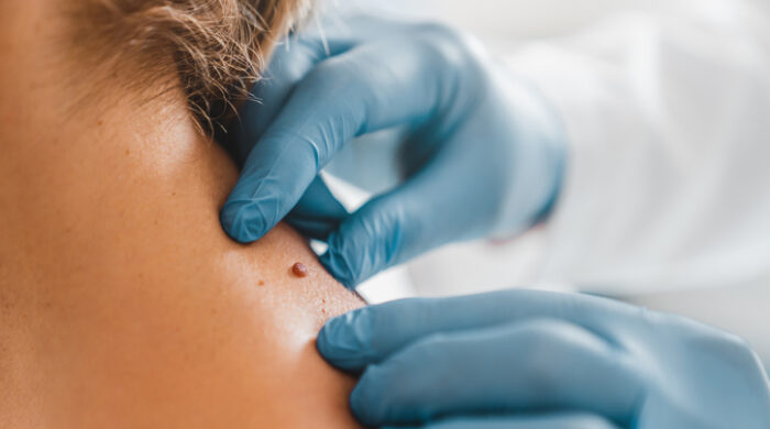 Close up of dermatologist examining patient birthmark in clinic