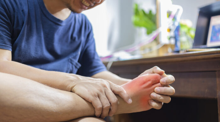 Man with painful and inflamed gout on his foot around the big toe area.