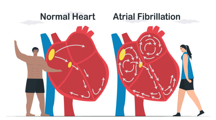 Data comparison of Normal heart and Atrial fibrillation. AF is common type of irregular heartbeat. Electrical signals in atrium cause atrium to beat quickly and erratically. cardiology vector.