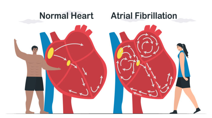 Data comparison of Normal heart and Atrial fibrillation. AF is common type of irregular heartbeat. Electrical signals in atrium cause atrium to beat quickly and erratically. cardiology vector.