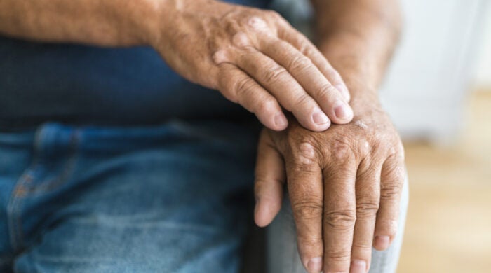 Elderly man suffering from psoriasis, closeup on hands