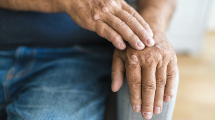 Elderly man suffering from psoriasis, closeup on hands