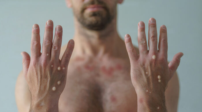 A male hands affected by blistering rash because of monkeypox or other viral infection on white background