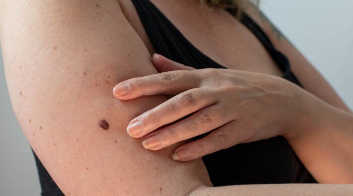 A woman with a concerning mole on her arm which needs to be removed