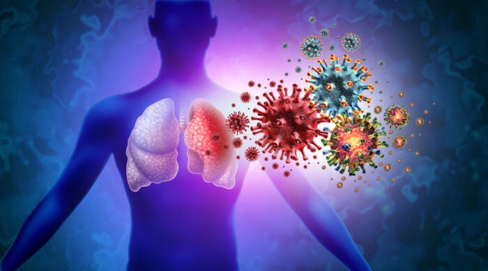 Triple Virus Lung Infection and Tripledemic Human lung infection and respiratory inflammation disease as influenza flu outbreak or pneumonia and pulmonary inflammatory illness with 3D illustration elements.