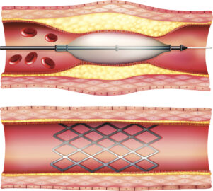 Illustration of the stent placement via angioplasty showing how it opens a blocked artery and the stent after the balloon is removed