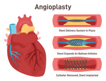graphic illustration of Angioplasty. Stent delivery and implantation. Deflated balloon catheter inserted into a coronary artery. Stent expanding a blood vessel wall. wwmg 